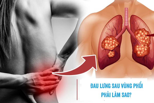 Đau sau lưng vùng phổi và cách massage giảm đau