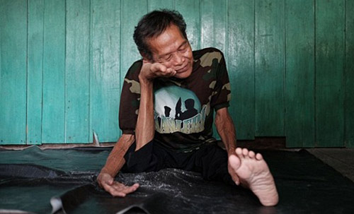 Cụ ông “không xương” ở Indonesia - 2